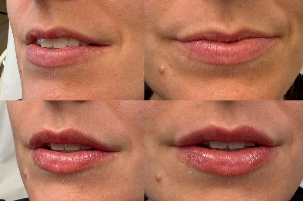0.5ml vs 1ml Lip Filler