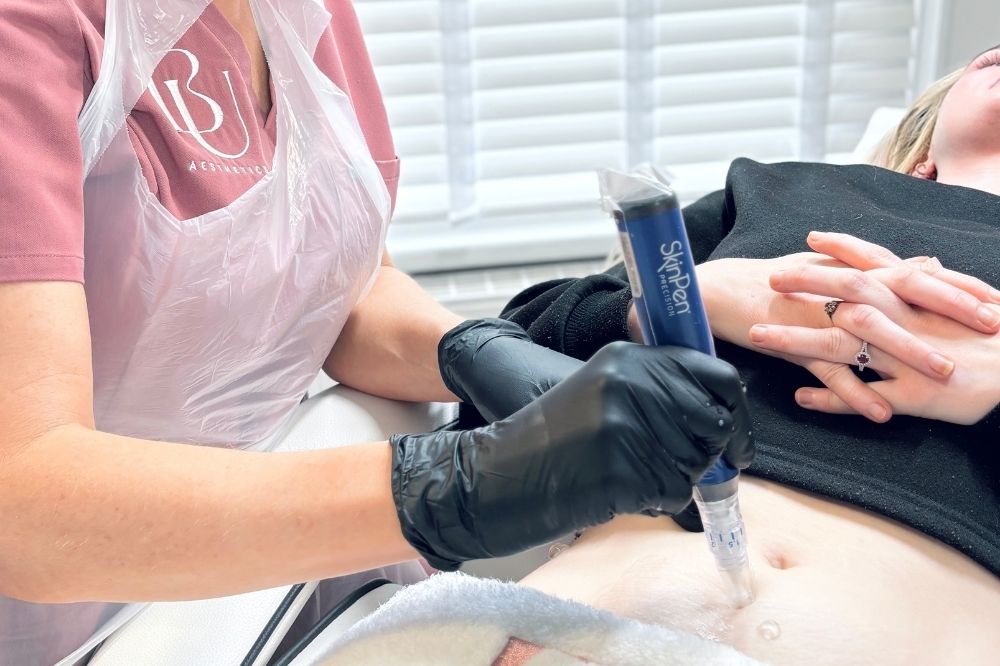 Microneedling for Stretch Marks